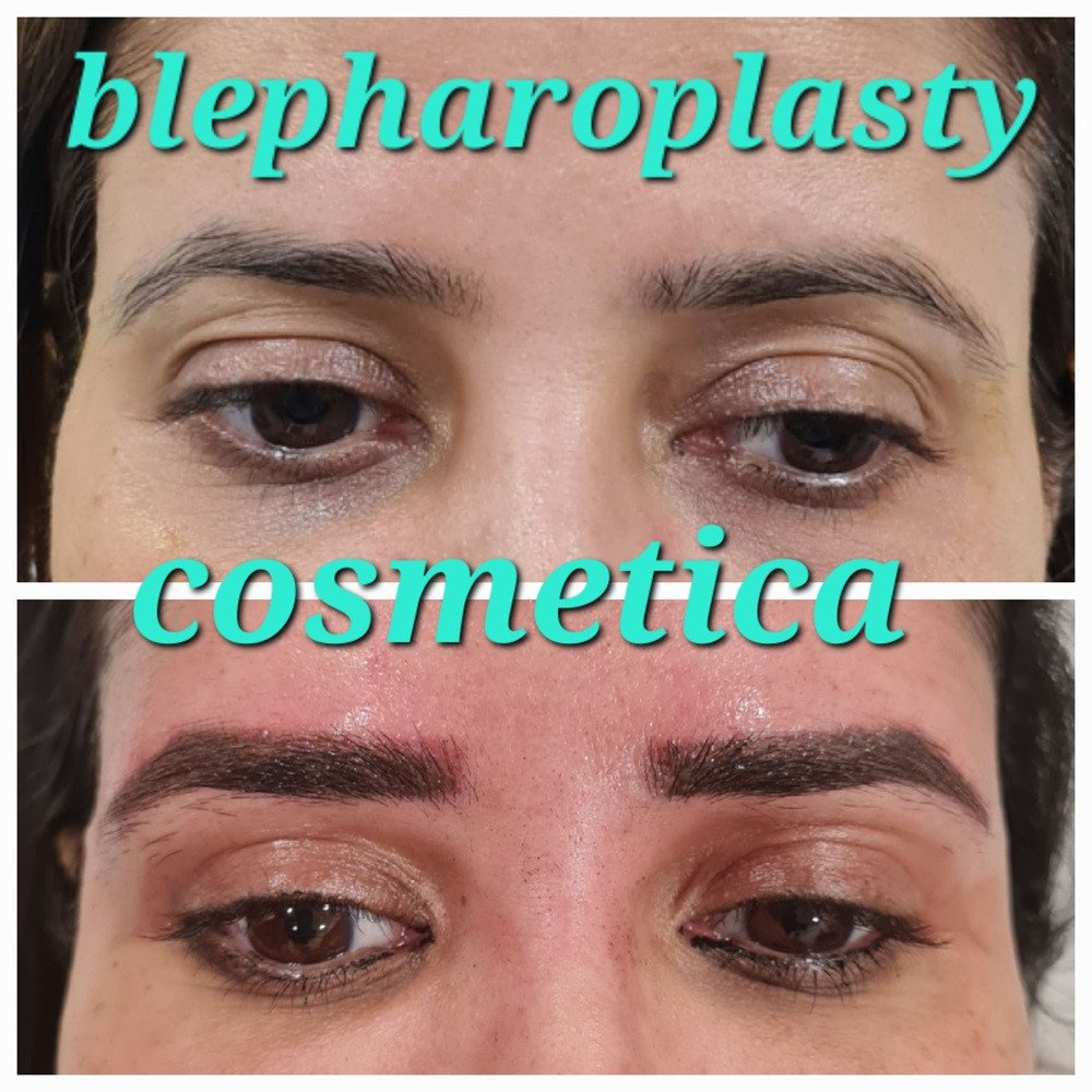 eyelid surgery