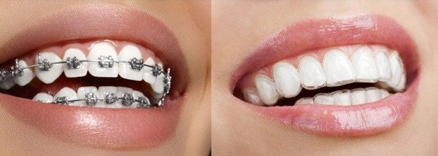 Traditional Braces Vs Clear Aligners