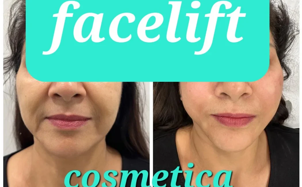 Face Lifting Treatment