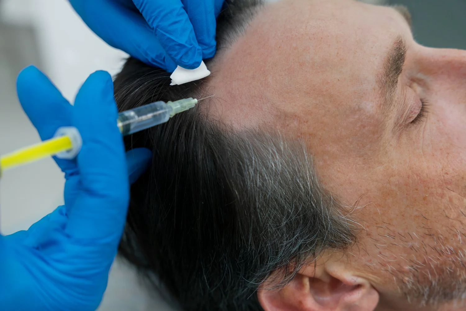 Hair Transplant