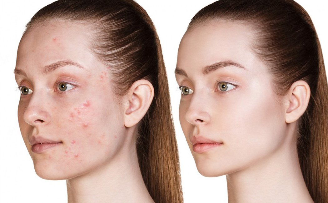 Acne Treatment in Delhi