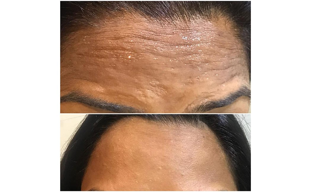 Wrinkle and Scar Reduction